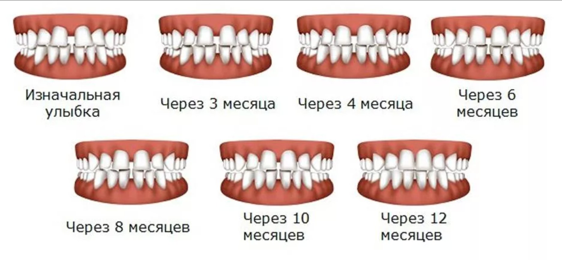 Что быстрее выравнивает зубы? 