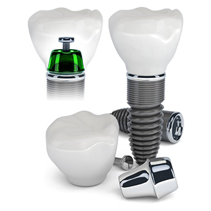 Имплантация Dentium «под ключ»
